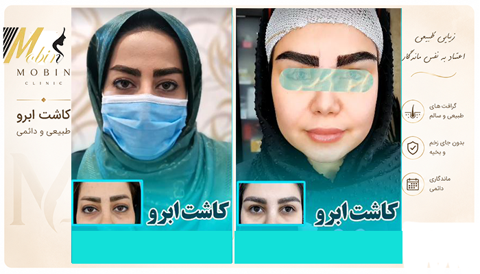 نمونه کار کاشت ابرو کلینیک مبین 2