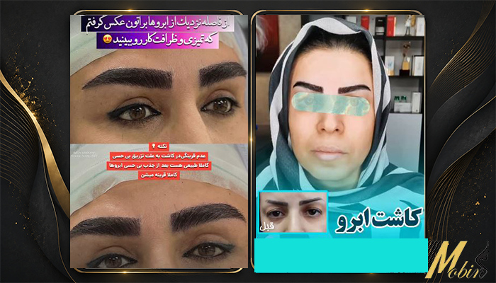 نمونه کار کاشت ابرو کلینیک مبین 3