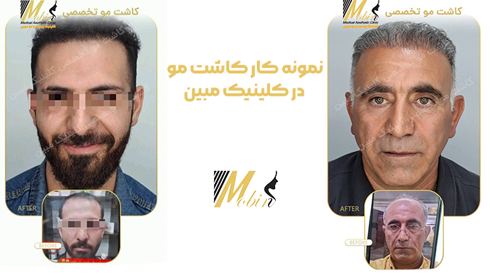 نمونه کار کاشت مو در کلینیک مبین