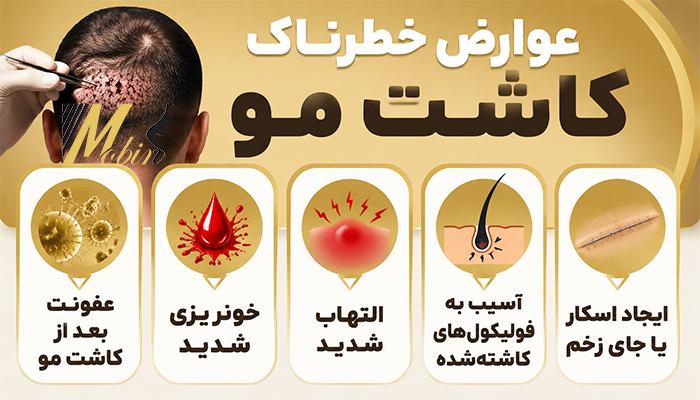 عوارض خطرناک کاشت مو
