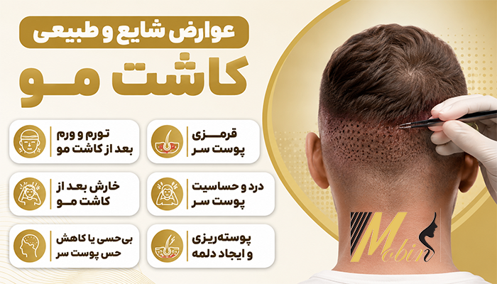 عوارض شایع و طبیعی کاشت مو