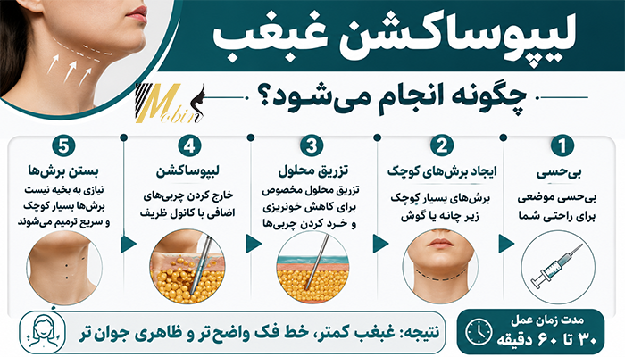 نحوه انجام لیپوساکشن غبغب