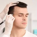 بهترین سن کاشت مو